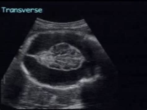 Schizencephaly – ULTRASOUNDPAEDIA