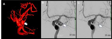 Catheter Angiogram of the Brain A. Three-dimensional rotational ...