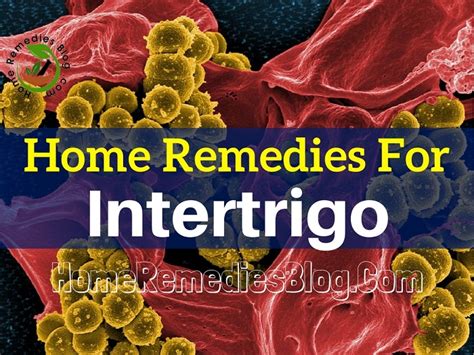 15 Home Remedies for Intertrigo (Rash in The Skin Folds) - Home Remedies Blog