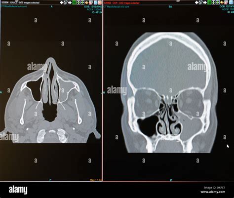 CT scan of male with sinus infection (sinusitis) filling the left Stock Photo: 154707847 - Alamy