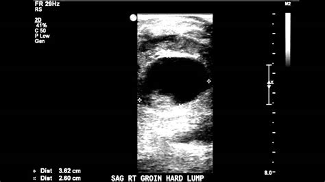 Pseudoaneurysm Evaluation: Post Angiogram - Case Study - YouTube