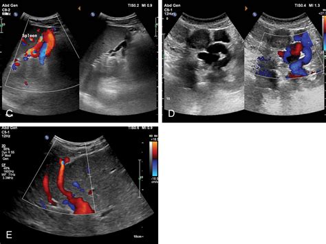 The role of ultrasound in portal hypertension | Radiology Key