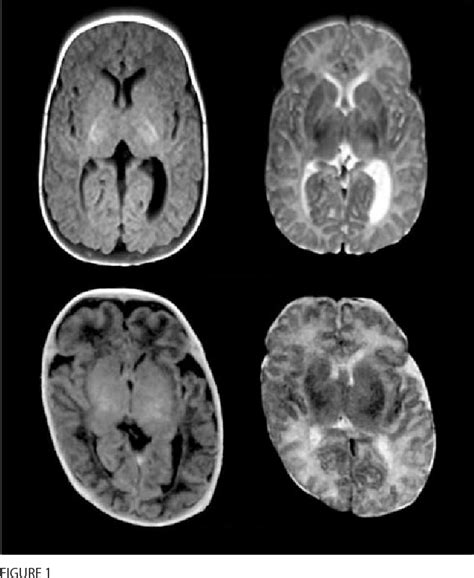 Figure 1 from Kernicterus in Preterm Infants | Semantic Scholar