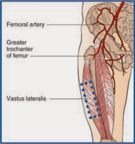 Vastus Lateralis Injection Site ~ Nursing