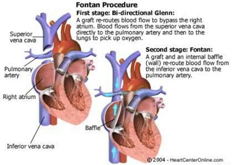 32 best Fontan Procedure images on Pinterest | Chd awareness, Cardiovascular disease and ...