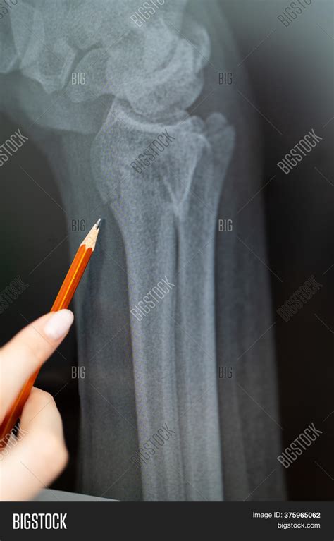 X-ray Broken Arm Image & Photo (Free Trial) | Bigstock