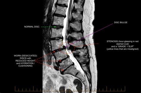 Normal versus abnormal lumbar anatomy | C.N.S. Neurosurgery