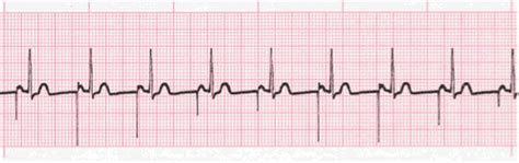 Pacemaker Rhythms: ECG class, criteria, tracings ...