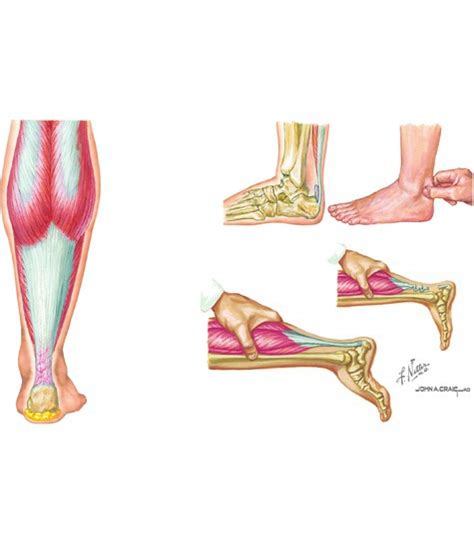 Calcaneal Tendon Rupture