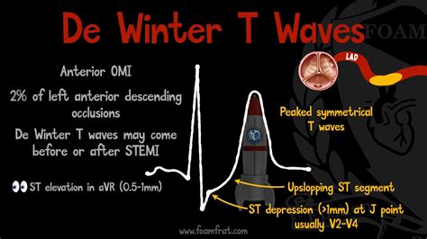 FOAMfrat - 2nd of the day. De Winter T Waves 🫀 Peaked T...