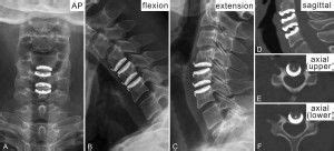 Differences between 1- and 2-level cervical arthroplasty - Neurosurgery ...