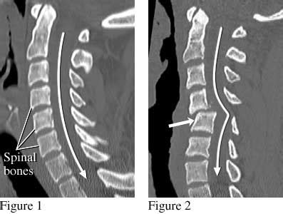 Cervical Spine (Neck) CT Scan | University of Michigan Health System