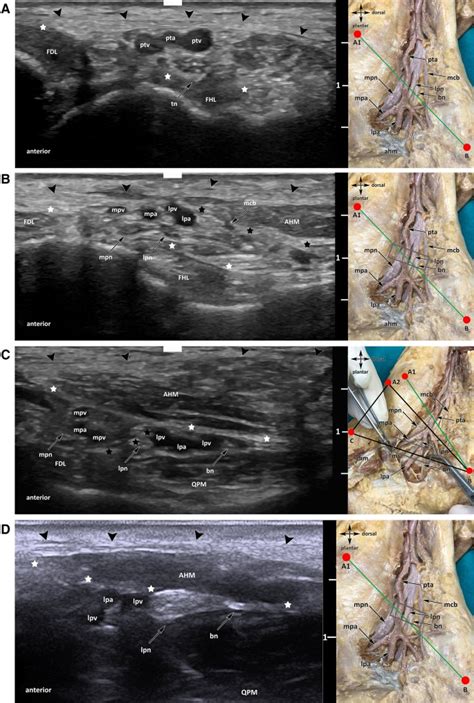 Clinical-anatomic mapping of the tarsal tunnel with regard to Baxter’s ...