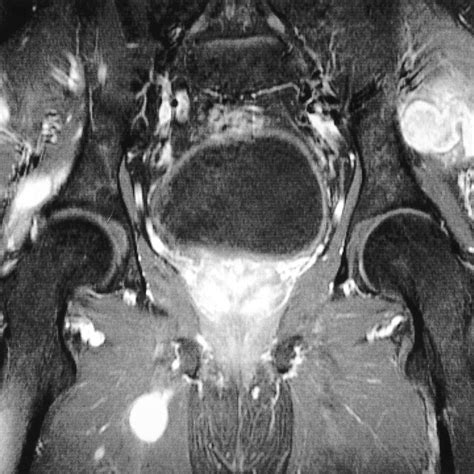 Follow up CT, ultrasonography, MR images 2 years after radical ...