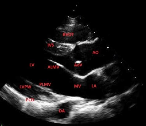 Normal Echocardiogram