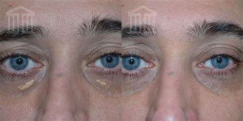 Xanthelasma Removal | Zenith Cosmetic Clinics