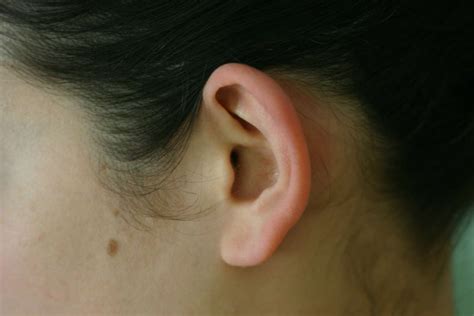 Sticking out Ears & Lobes - no-surgery and surgery options for all ages