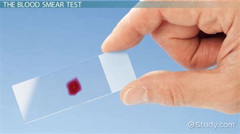 Blood Smear Test | Procedure & Possible Results - Lesson | Study.com