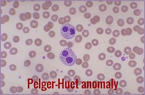 Pelger-Huët Anomaly | Ask Hematologist | Understand Hematology