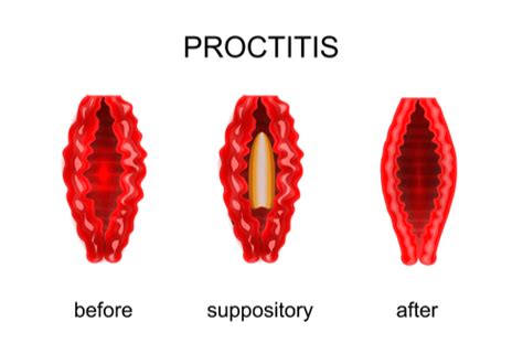 Proctitis : Overview, causes, types, symptoms, & treatment | FactDr