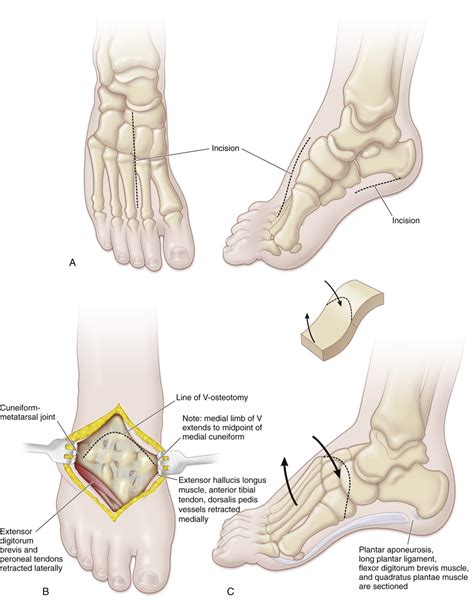 50 Japas V-Osteotomy of the Tarsus | Musculoskeletal Key