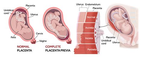 Placenta Accreta Symptoms Causes And Risks Pampers | The Best Porn Website