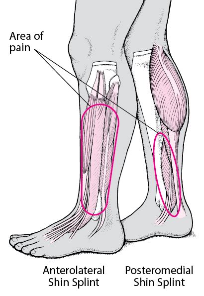 Table: Shin Splints - Merck Manuals Consumer Version