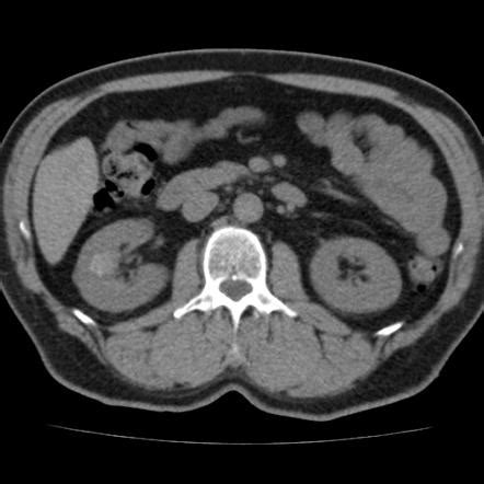 Milk of calcium renal cyst | Image | Radiopaedia.org