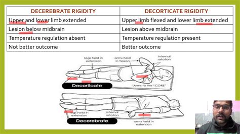 Corticate Vs Decorticate Posturing