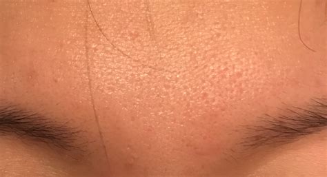 HELP! What kind of acne scars do I have? - Scar treatments - Acne.org