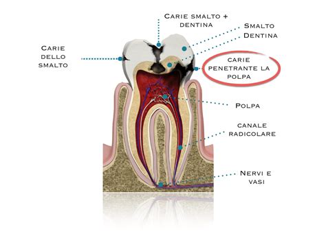 StudioDentisticoZemella Endodonzia e "devitalizzazioni"