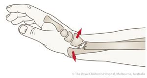 Clinical Practice Guidelines : Galeazzi fracture-dislocation ...