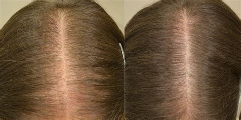 Topical Minoxidil (Females) Before & After Photos - Hair Restoration of the South - New Orleans, LA