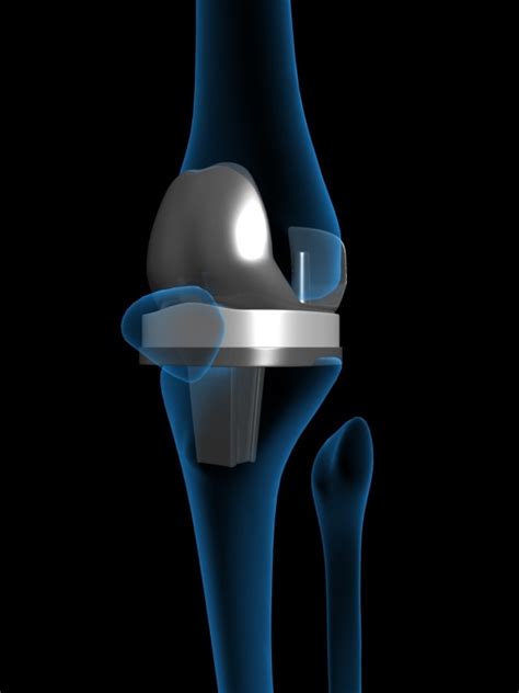 artificial knee replacement 3d model