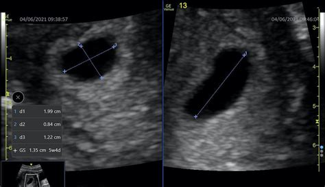 Sonography Assessment Of Gestational Age Article