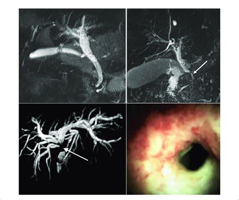 | Top left: Magnetic resonance imaging (MRI) of a normal biliary tree.... | Download Scientific ...