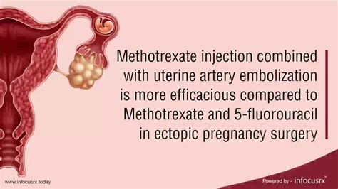 Methotrexate combined with uterine artery embolization is efficacious to Methotrexate ...