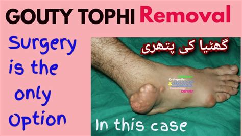 Gout Surgery of foot II Ghatiya kee Pathree II Large Gouty Tophi Removal || Dr. Khaqan - YouTube