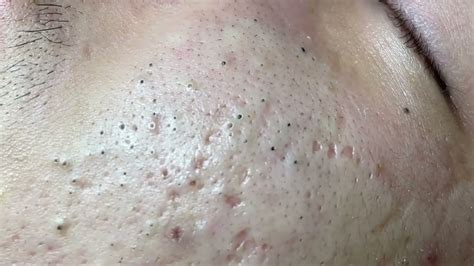 Blackheads Removal with Hari - Satisfying