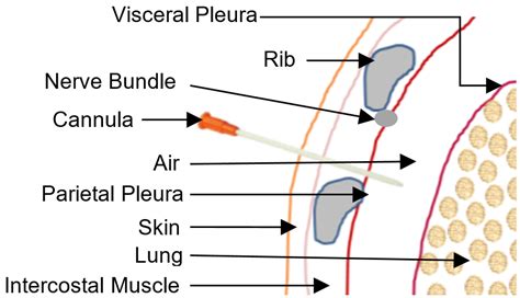 Needle Thoracocentesis