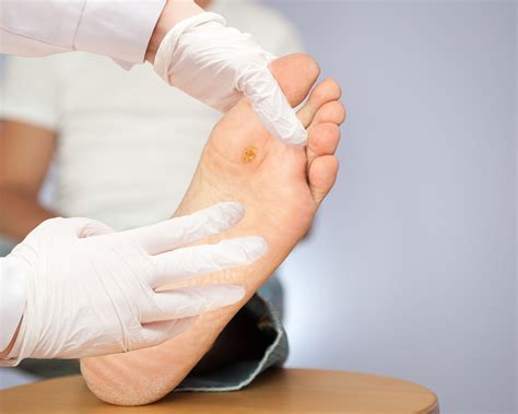 Plantar Warts - Southernmost Foot & Ankle Specialists