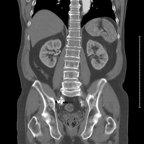 catscan, spine, kidneys, hipbone, xray, bones, medical, joints | Piqsels