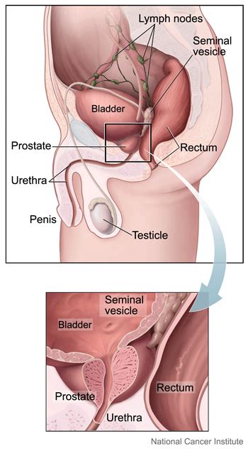 Understanding Prostate Cancer | Knight Cancer Institute | OHSU