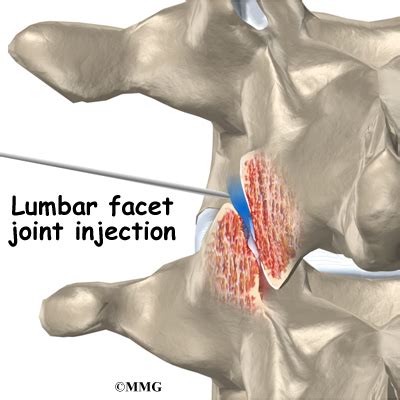 Facet Joint Injections | eOrthopod.com