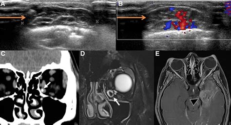 Imaging of venous malformations. (A,B) US of a venous malformation of... | Download Scientific ...