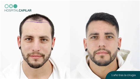 PREMATURE BALDNESS: How to combat it?