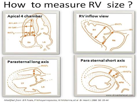 What is the normal RV size ? How to measure it by echocardiography ...