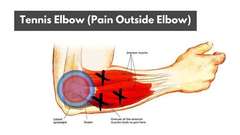 Tennis Elbow (A Helpful Guide) - TitaniumPhysique