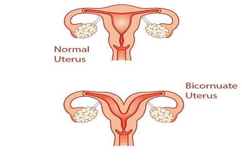 Effects of Bicornuate Uterus on Pregnancy & Its Treatment