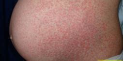 Puppp Rash - Pictures, Symptoms, Causes, Treatment, What is